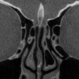 Cópia de drenagem frontal