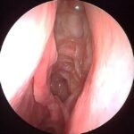 Cópia de good-post-sinus-surgery-caivty